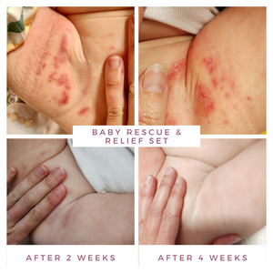 Baby Rescue and Relief Set Island Goddess Organics, Mumma and Monkey Range. Before and After photos nappy rash with open wounds. Oatmeal and Coconut Milk Bath and Nourish and Nurture Baby Oil organic 